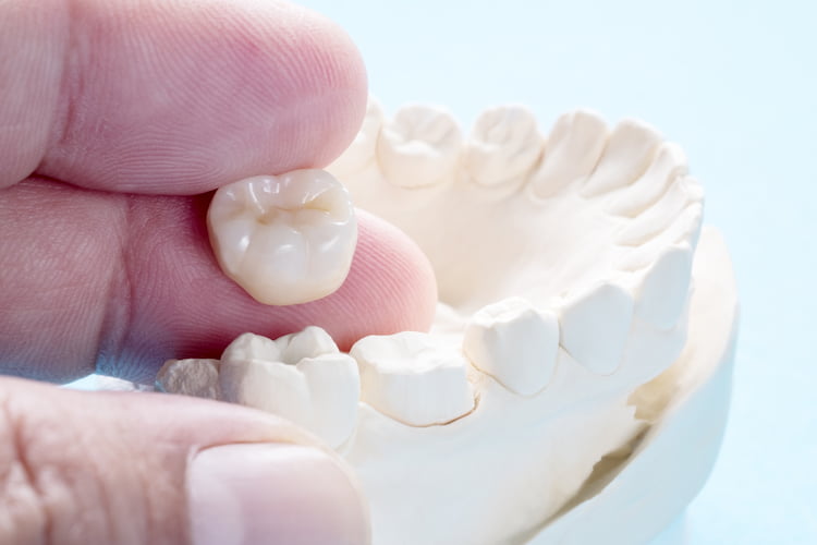 Dental Crowns And Bridges