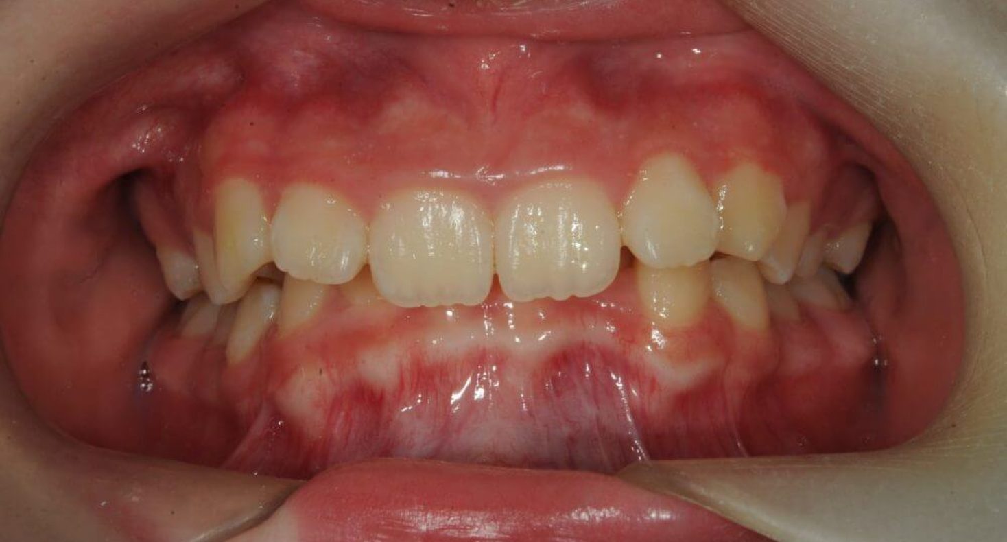 Before